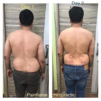 painflame chiropractic physiotherapy