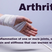  Arthritis Treatment 